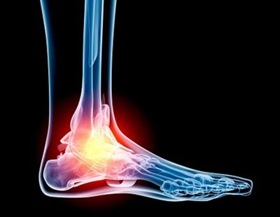 Lesioni osteocondrali di caviglia